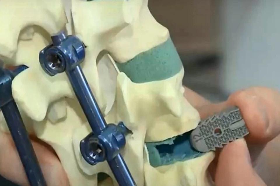 Surgeons are ditching expensive foreign implants for a groundbreaking local innovation! With 25 successful surgeries already, this game-changing titanium intervertebral disc is revolution...